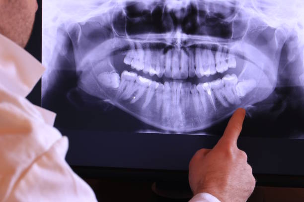 Best Emergency Wisdom Teeth Removal in Huntley, IL